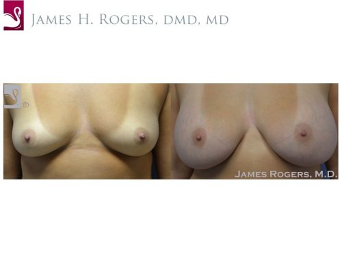 Breast Augmentation Case #29756 (Image 1)