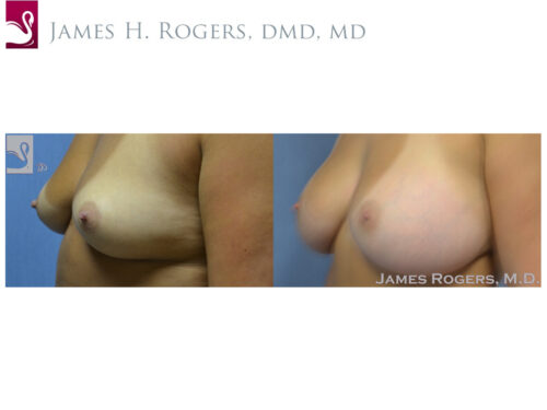 Breast Augmentation Case #29756 (Image 3)
