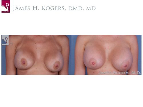 Breast Revisions Case #36278 (Image 1)