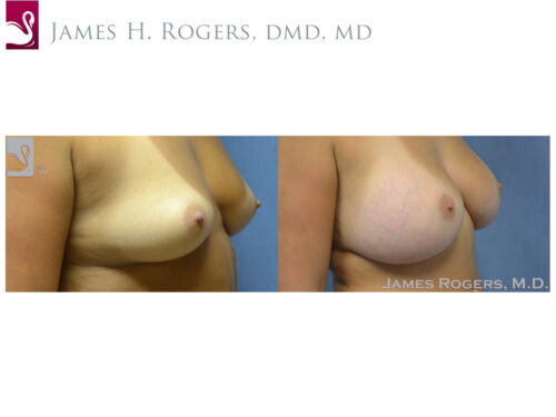 Breast Augmentation Case #29756 (Image 2)