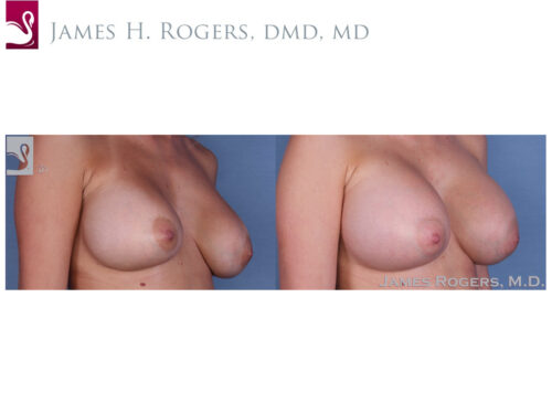 Breast Revisions Case #36278 (Image 2)