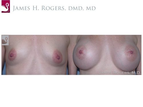 Breast Augmentation Case #37580 (Image 1)