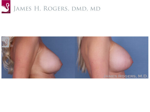 Breast Revisions Case #36278 (Image 3)