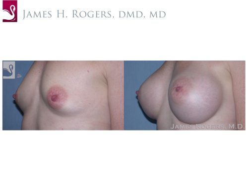 Breast Augmentation Case #37580 (Image 3)