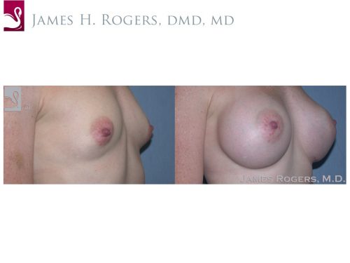 Breast Augmentation Case #37580 (Image 2)