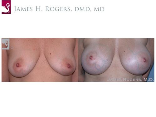 Breast Augmentation Case #45650 (Image 1)