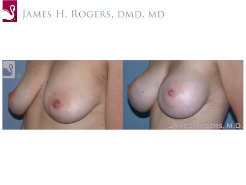 Breast Augmentation Case #45650 (Image 3)
