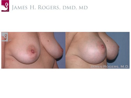 Breast Augmentation Case #45650 (Image 2)
