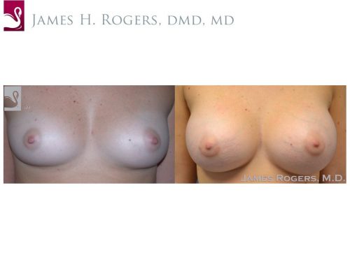 Breast Augmentation Case #48966 (Image 1)