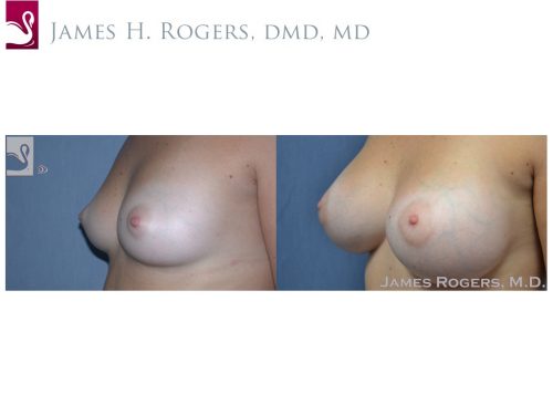 Breast Augmentation Case #48966 (Image 3)