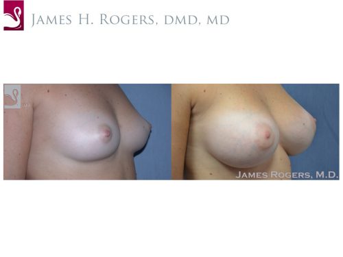 Breast Augmentation Case #48966 (Image 2)