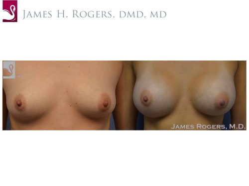 Breast Augmentation Case #48986 (Image 1)