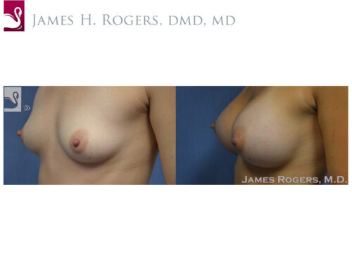 Breast Augmentation Case #48986 (Image 3)