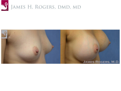 Breast Augmentation Case #48986 (Image 2)