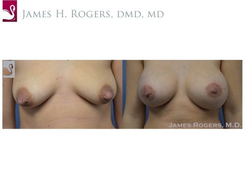 Breast Augmentation Case #50609 (Image 1)