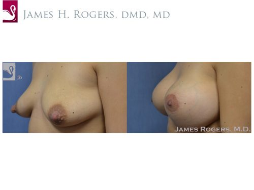 Breast Augmentation Case #50609 (Image 3)