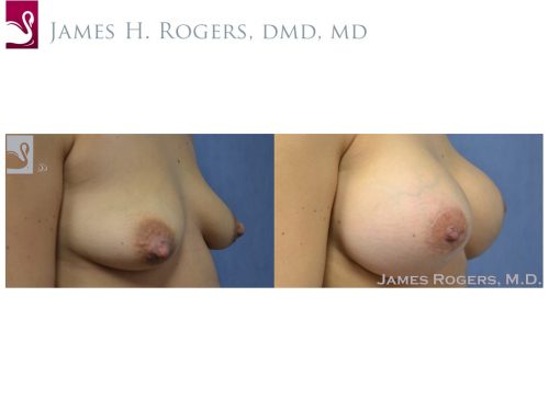 Breast Augmentation Case #50609 (Image 2)
