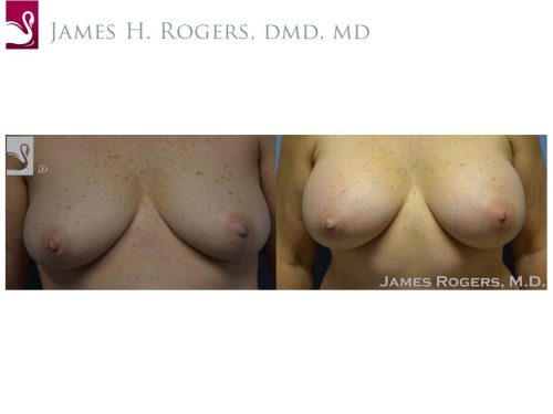 Breast Augmentation Case #52304 (Image 1)