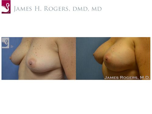Breast Augmentation Case #52304 (Image 3)