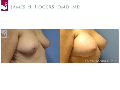 Breast Augmentation Case #52304 (Image 2)