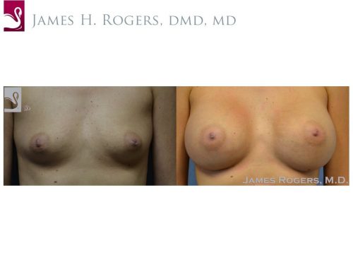 Breast Augmentation Case #52769 (Image 1)