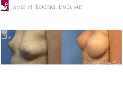 Breast Augmentation Case #52769 (Image 3)