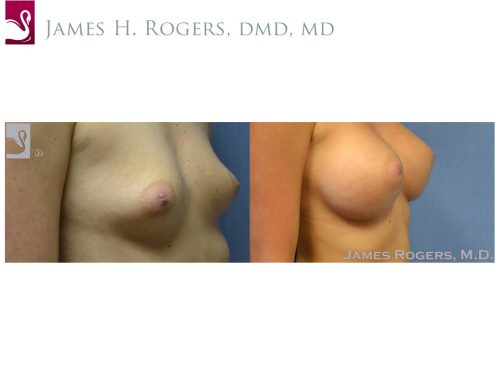 Breast Augmentation Case #52769 (Image 2)
