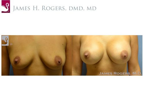 Breast Augmentation Case #53657 (Image 1)