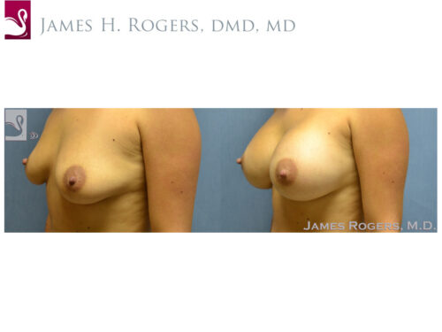 Breast Augmentation Case #53657 (Image 3)