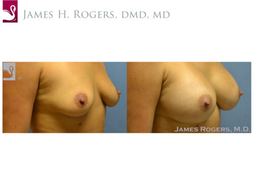 Breast Augmentation Case #53657 (Image 2)