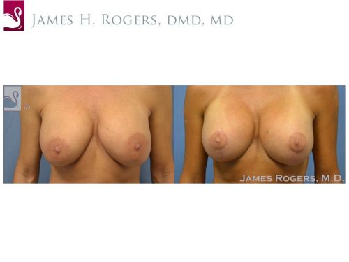 Breast Revisions Case #30036 (Image 1)