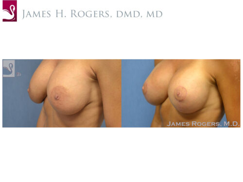 Breast Revisions Case #30036 (Image 3)