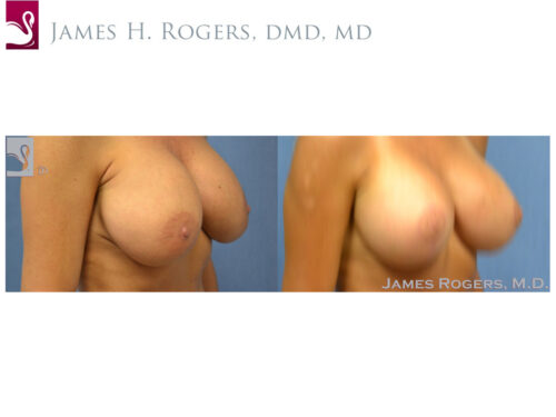 Breast Revisions Case #30036 (Image 2)