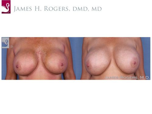 Breast Revisions Case #23065 (Image 1)