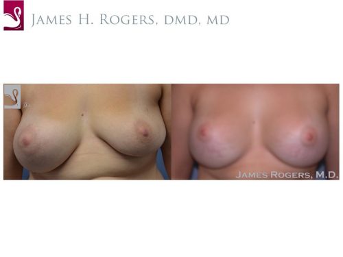 Breast Revisions Case #38335 (Image 1)