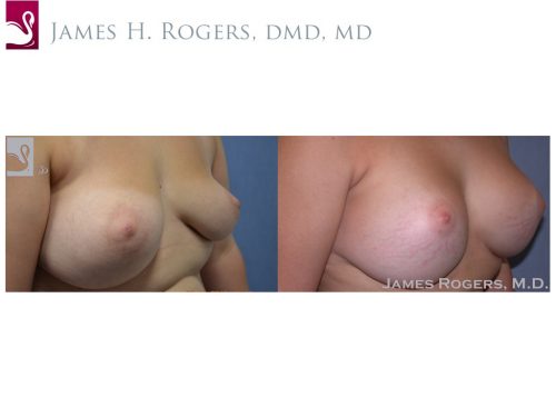 Breast Revisions Case #38335 (Image 2)