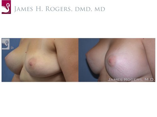 Breast Revisions Case #38335 (Image 3)