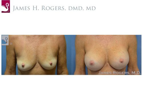 Breast Augmentation Case #23716 (Image 1)