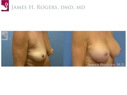 Breast Augmentation Case #23716 (Image 2)