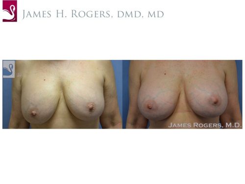 Breast Revisions Case #35498 (Image 1)
