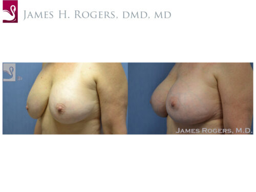 Breast Revisions Case #35498 (Image 3)