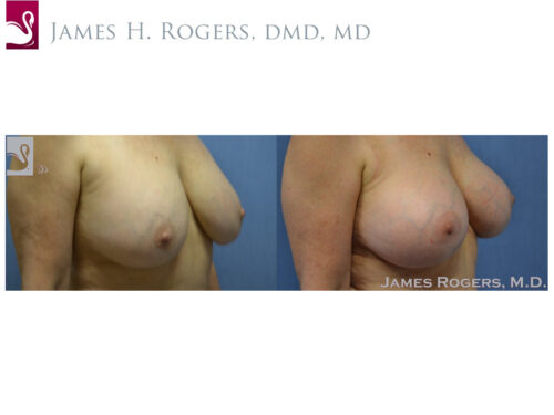 Breast Revisions Case #35498 (Image 2)