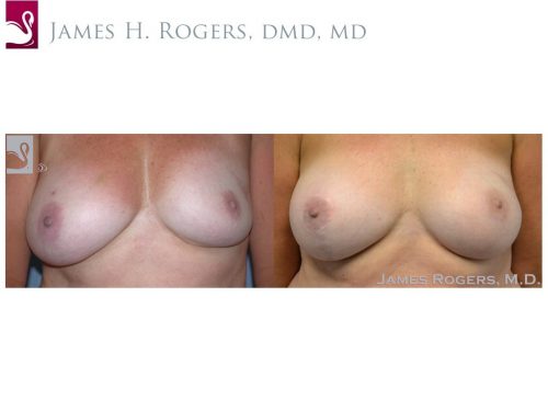 Breast Reconstruction Case #41320 (Image 1)
