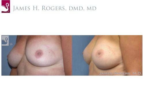Breast Reconstruction Case #41320 (Image 3)