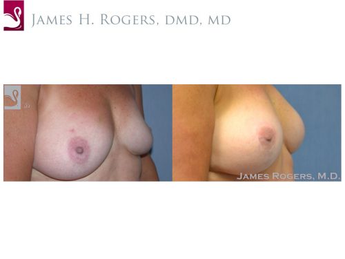 Breast Reconstruction Case #41320 (Image 2)