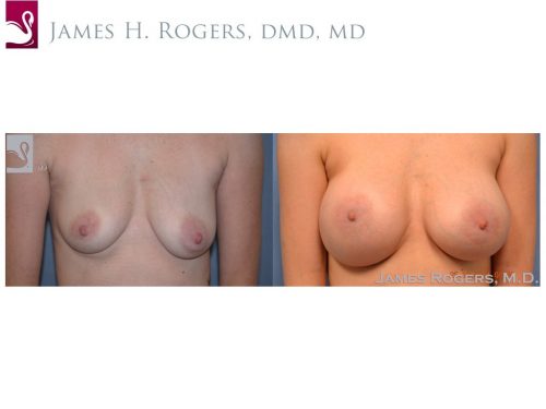 Breast Augmentation Case #48425 (Image 1)