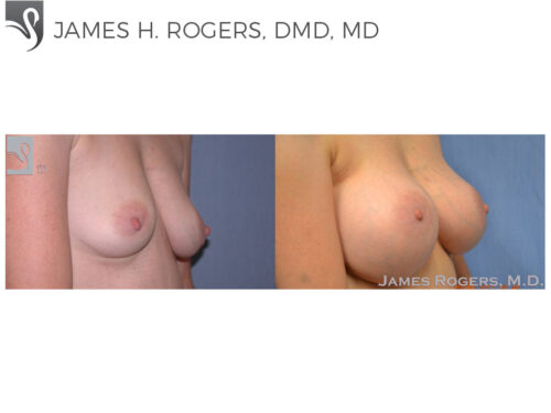 Breast Augmentation Case #48425 (Image 2)