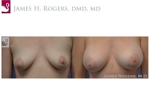 Breast Augmentation Case #50721 (Image 1)