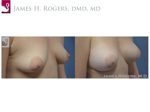 Breast Augmentation Case #50721 (Image 2)