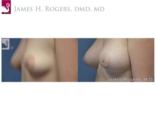 Breast Augmentation Case #50721 (Image 3)